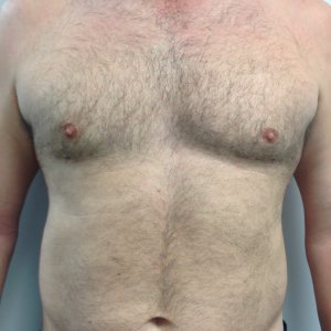 manhattan gynecomastia surgery after 3